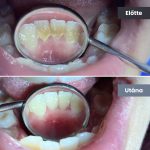 Park Dental Dentálhigiéniai kezelések | előtte-utána