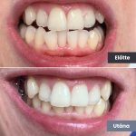 Park Dental Dentálhigiéniai kezelések | előtte-utána