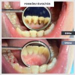 Park Dental Dentálhigiéniai kezelések | előtte-utána