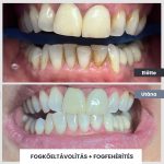 Park Dental Dentálhigiéniai kezelések | előtte-utána