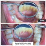 Park Dental Dentálhigiéniai kezelések | előtte-utána