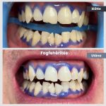 Park Dental Dentálhigiéniai kezelések | előtte-utána