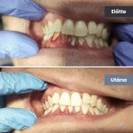 Park Dental Dentálhigiéniai kezelések | előtte-utána