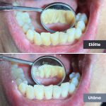 Park Dental Dentálhigiéniai kezelések | előtte-utána