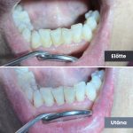 Park Dental Dentálhigiéniai kezelések | előtte-utána