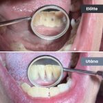 Park Dental Dentálhigiéniai kezelések | előtte-utána