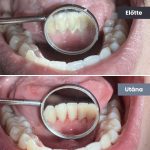 Park Dental Dentálhigiéniai kezelések | előtte-utána