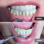 Park Dental Dentálhigiéniai kezelések | előtte-utána