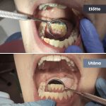 Park Dental Dentálhigiéniai kezelések | előtte-utána