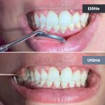 Park Dental Dentálhigiéniai kezelések | előtte-utána