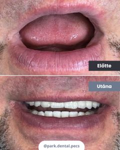 Park Dental Pécs | Fogászati implantátum