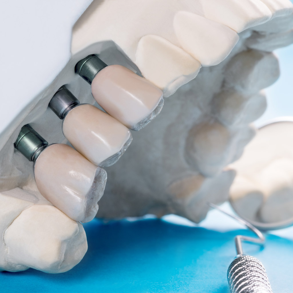 Park Dental | implantátum károsodása