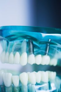 Park Dental | implantátum károsodása