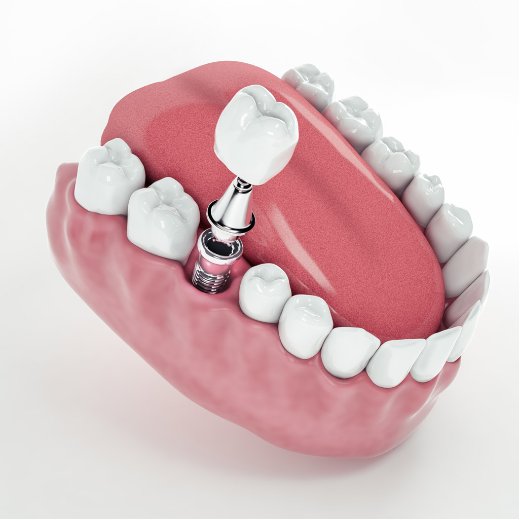 Park Dental | implantátum károsodása