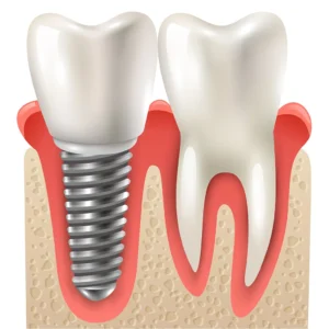 Mikor és miért van szükség csontpótlásra az implantáció előtt?
